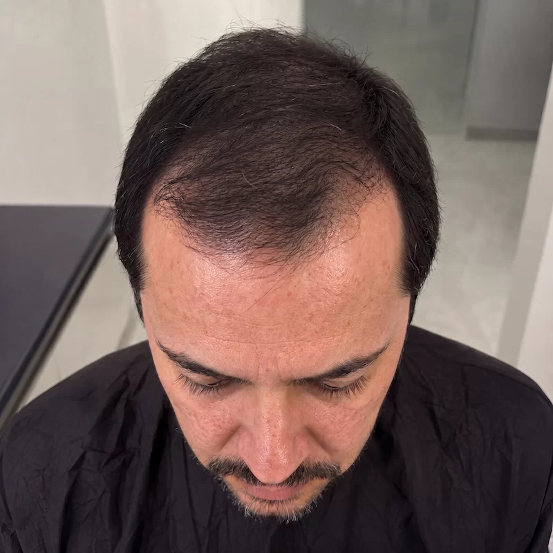 Antes del tratamiento de injerto capilar FUE en MásHair