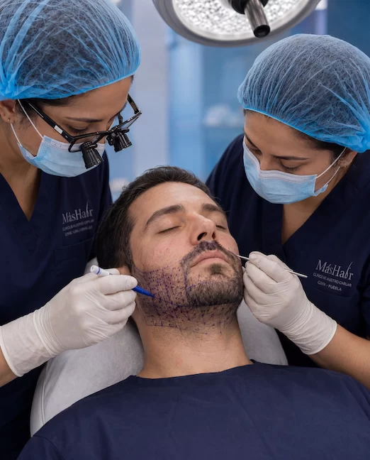 Resultado de injerto de barba en MásHair CDMX y Puebla