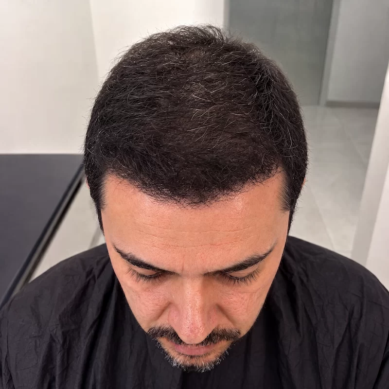 Después del tratamiento de injerto capilar FUE en MásHair